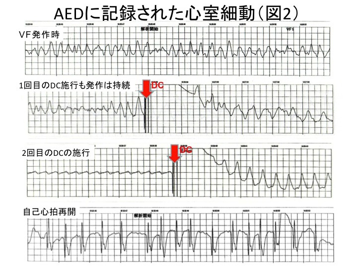 図2　AED記録