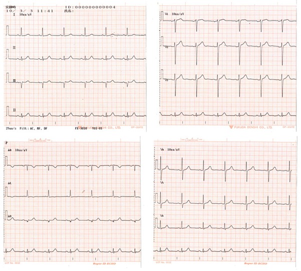 図A　2010年3月3日の心電図