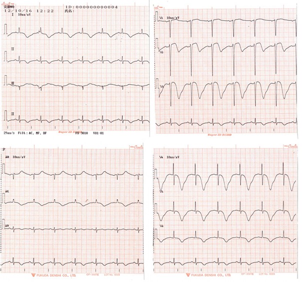 図B　2012年10月16日の心電図