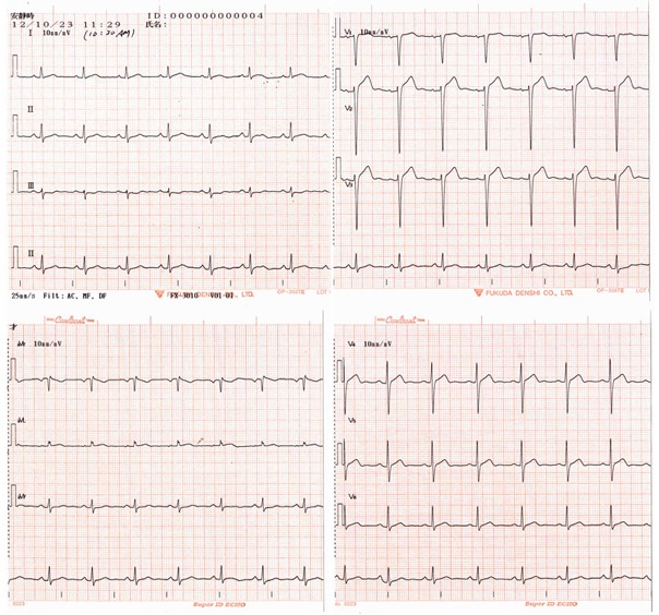 図C　2012年10月23日の心電図