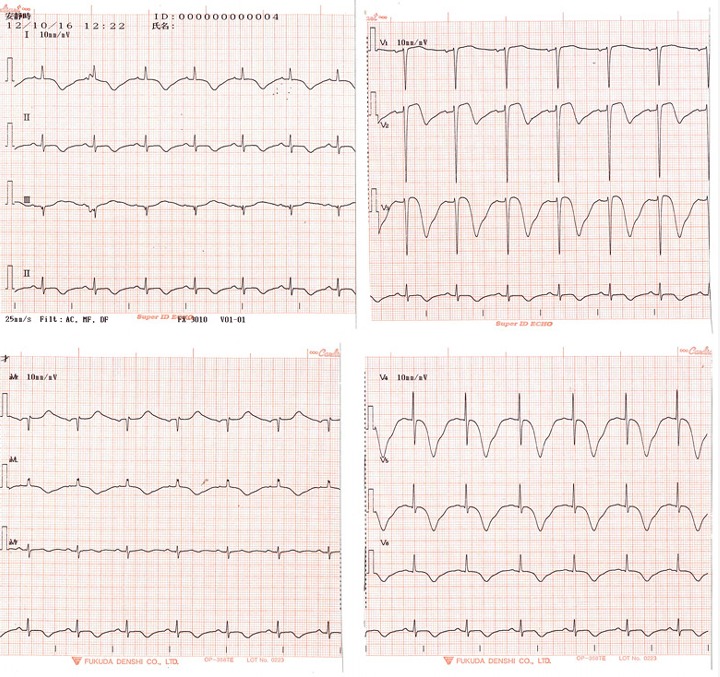 75歳　女性　心電図