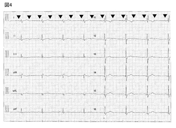心電図4
