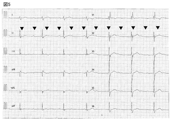 心電図5