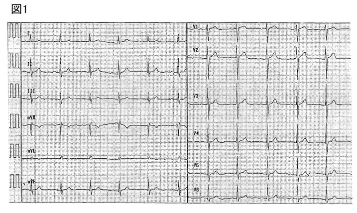70代　女性　心電図1