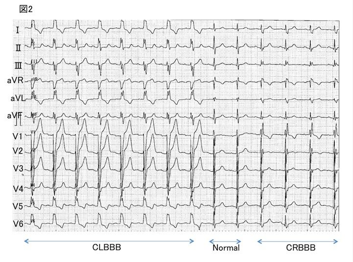 70代　女性　心電図2
