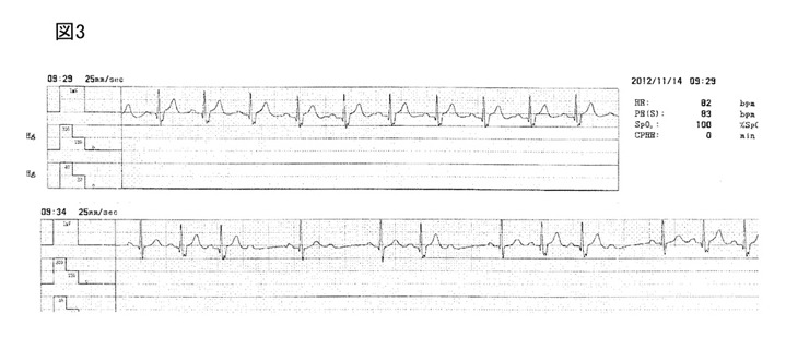 70代　女性　心電図3