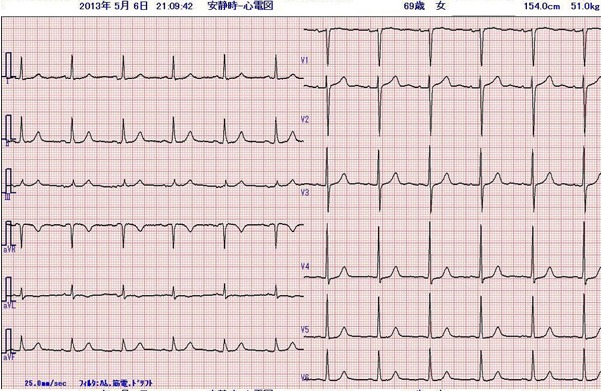術前心電図