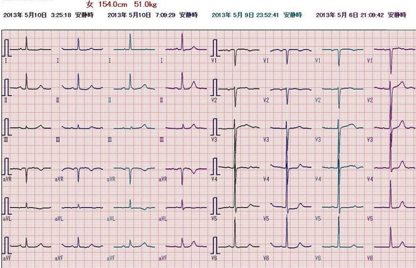 心電図の経過