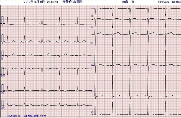 69歳　女性　心電図