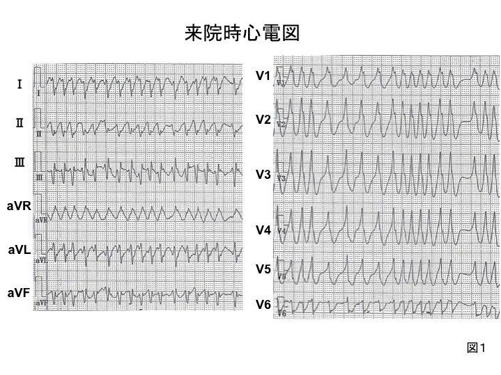 図1 来院時心電図