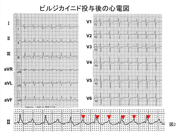 図2 ピルジニカイド投与後の心電図