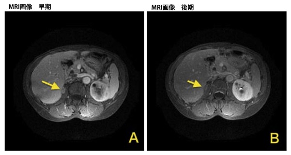 MRI画像