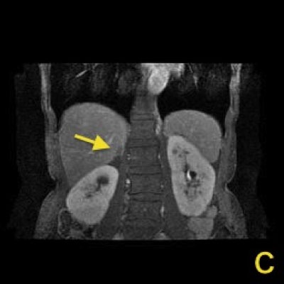 MRI画像　右副腎腫瘍