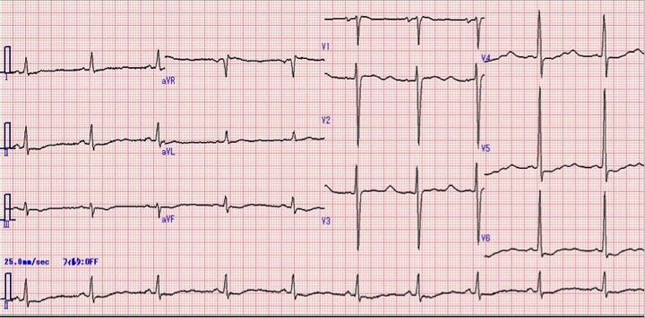 52歳　女性　心電図