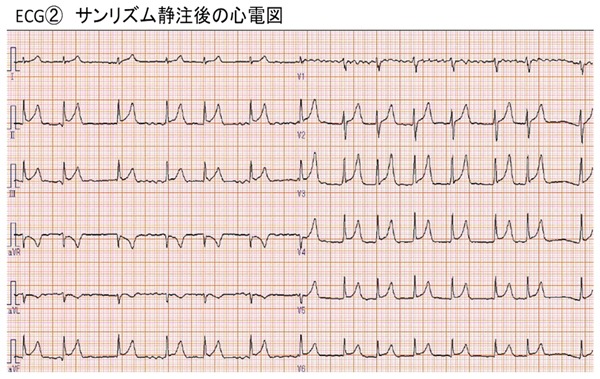 ECG2　サンリズム静注後の心電図