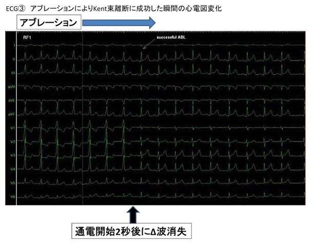 ECG③ アブレーションによりKent束離断に成功した瞬間の心電図変化