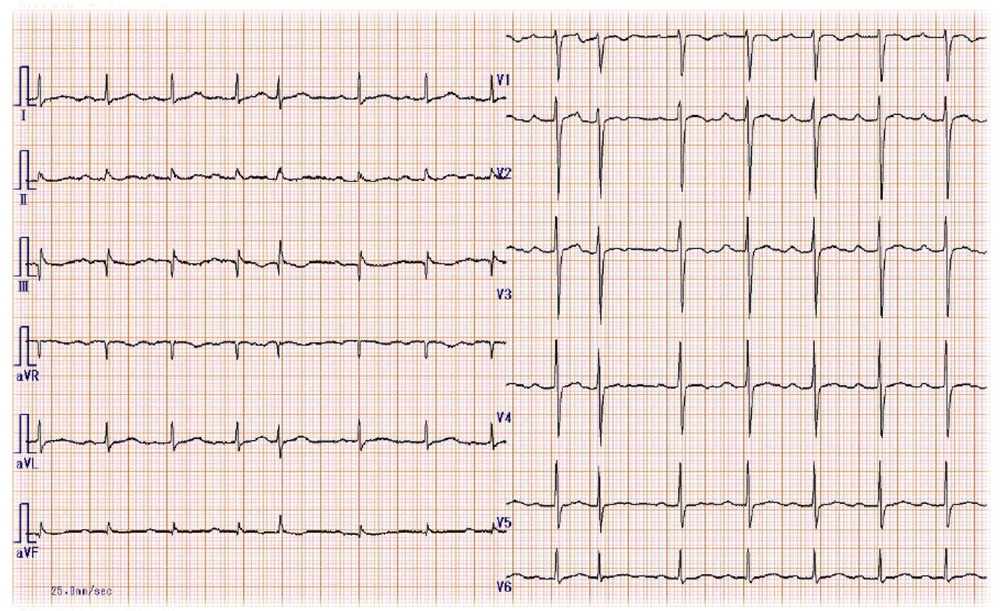 発症2ヶ月前の心電図