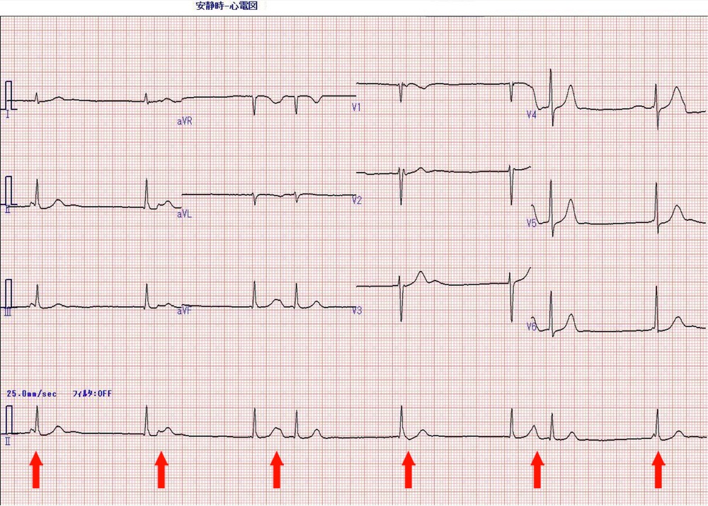 問題の心電図