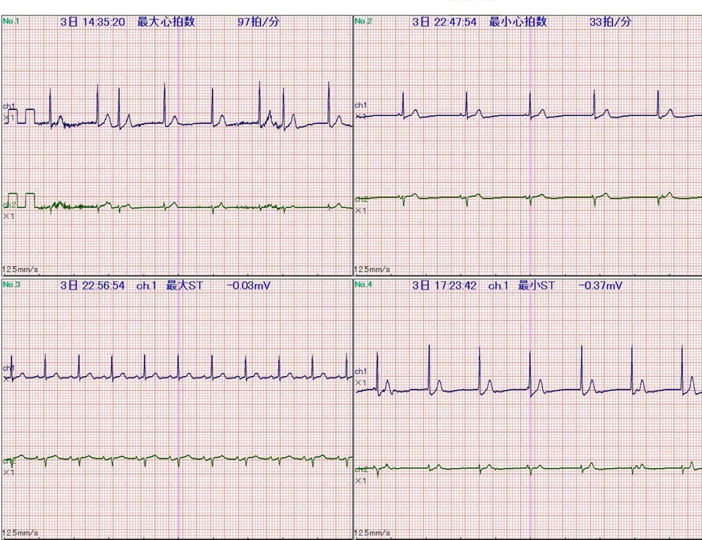 ホルター心電図1
