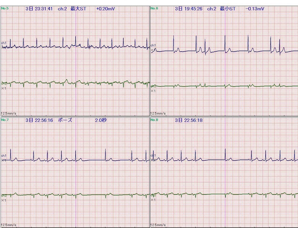 ホルター心電図2