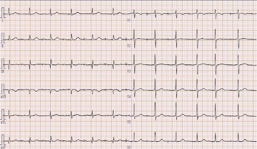 3ヶ月前の心電図