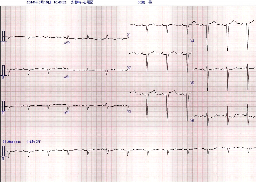 2014年 来院時の心電図