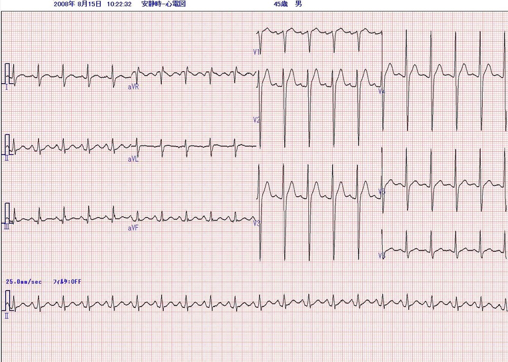 2008年 入院時の心電図