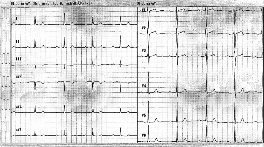 心電図(3)ステロイド投与12日目