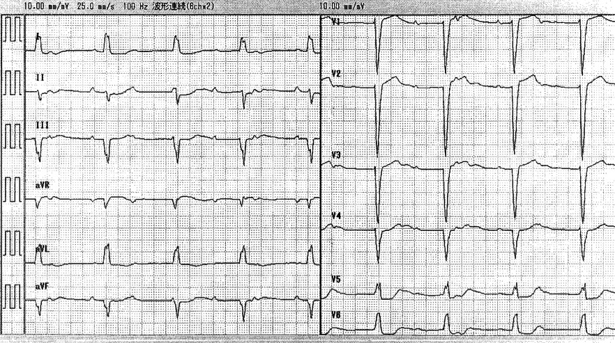 入院時の心電図