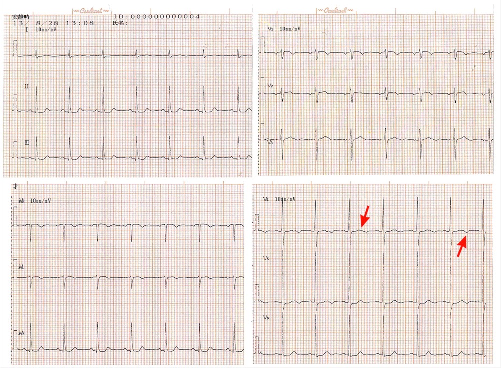 問題の心電図