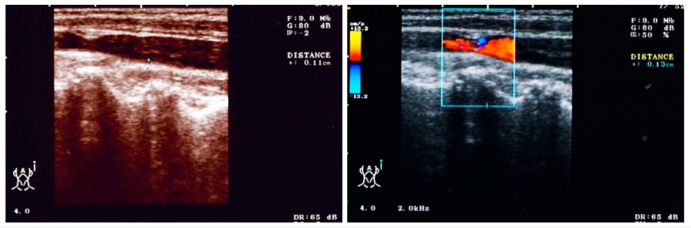 エコー画像2点　左：左頸動脈上部エコー図　右：狭窄部前後の血流変化を示すカラーエコー図