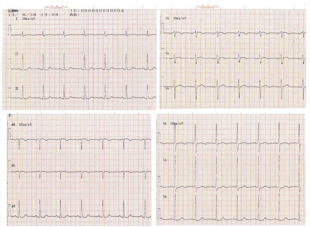 73歳女性　心電図
