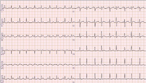 18歳女性　入院時の心電図