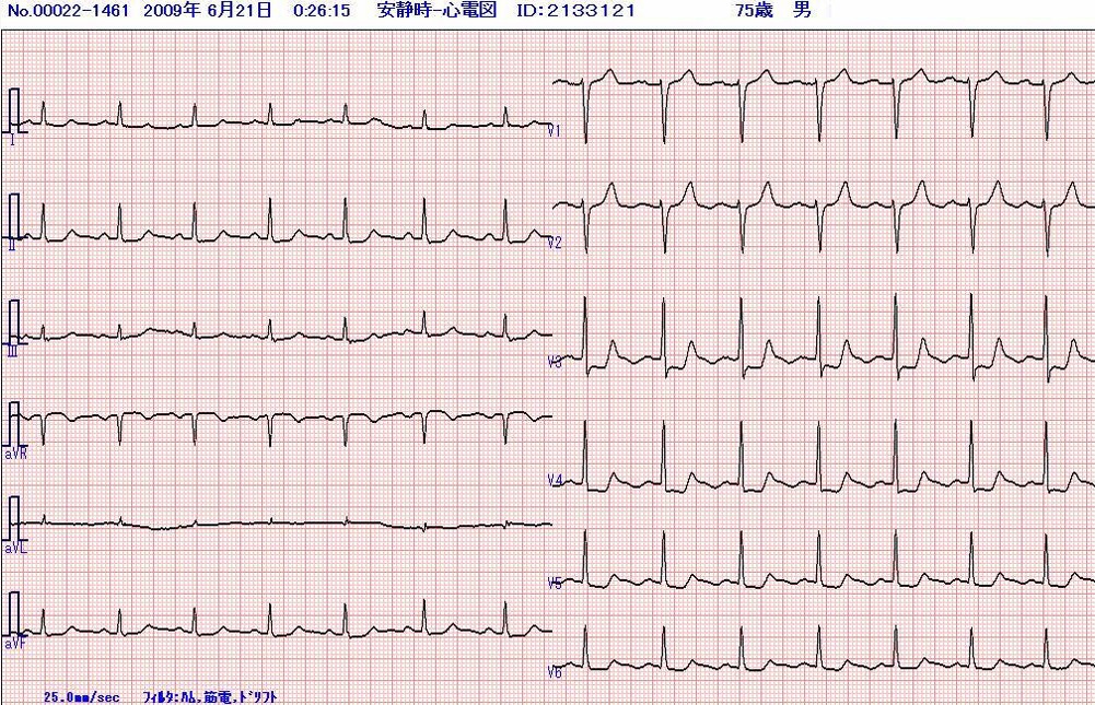 過去の心電図(C)