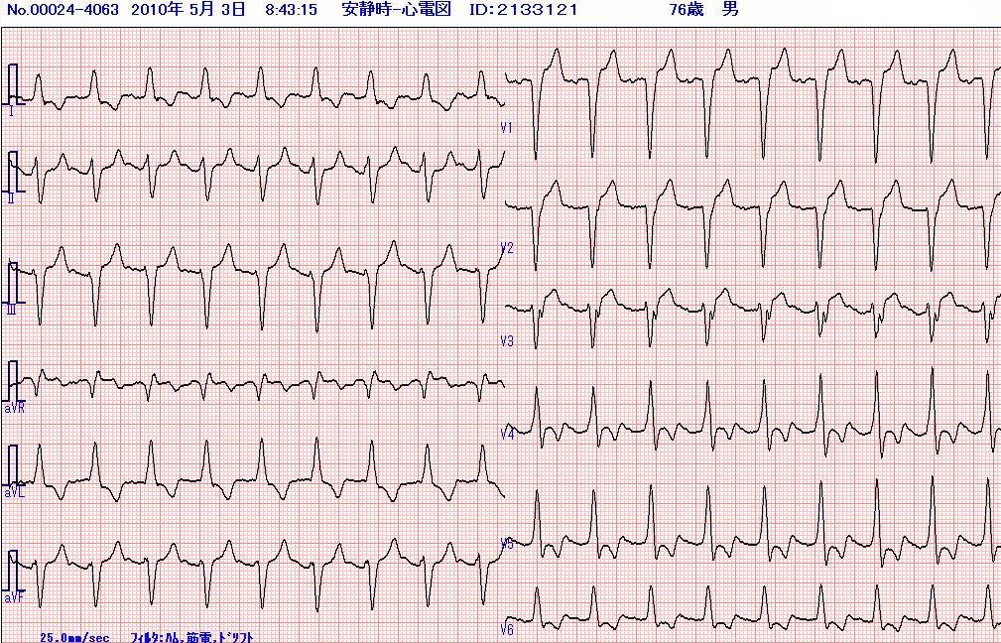心電図(D)