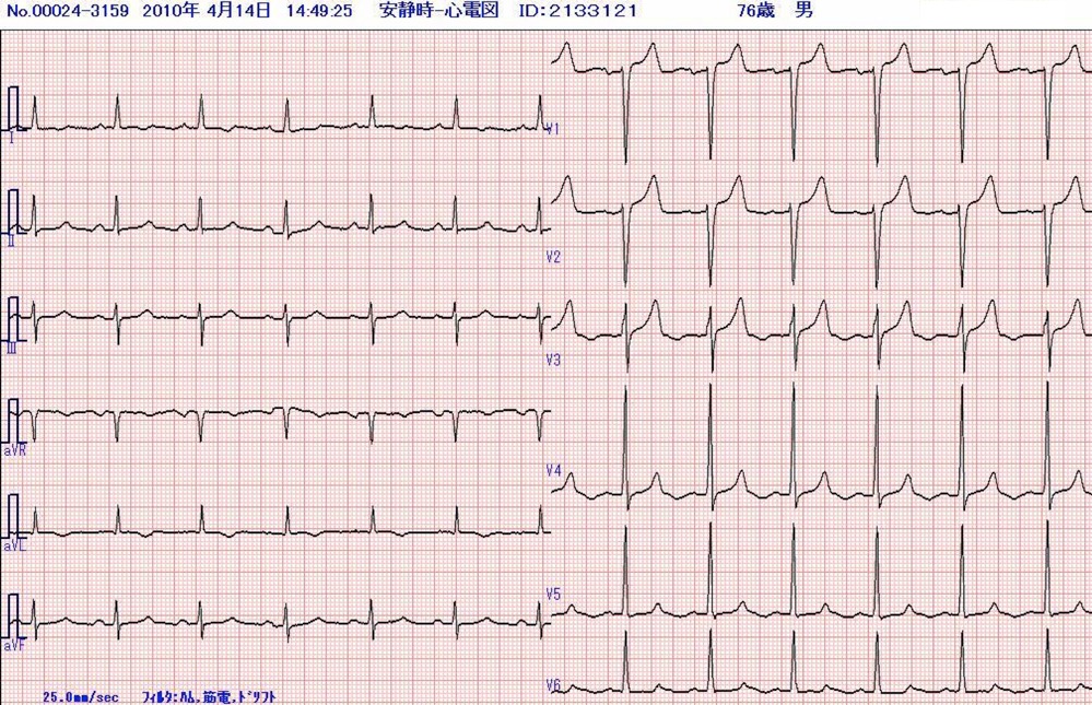 76歳男性　来院時の心電図