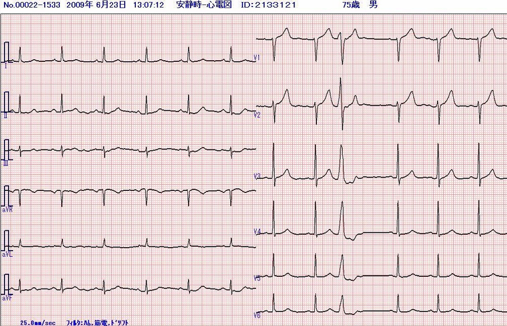 76歳男性　過去の心電図