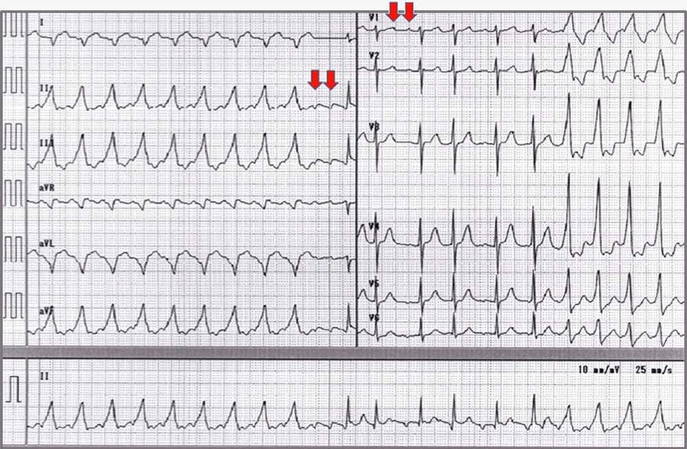 問題の心電図2（再掲）