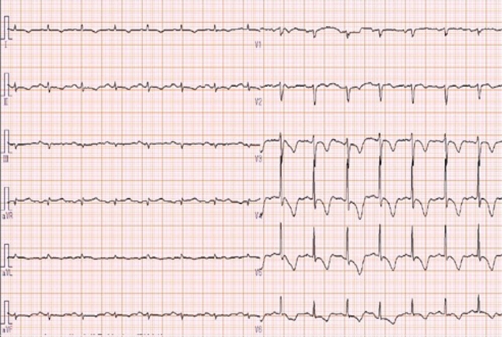 図3　発症翌日のECG