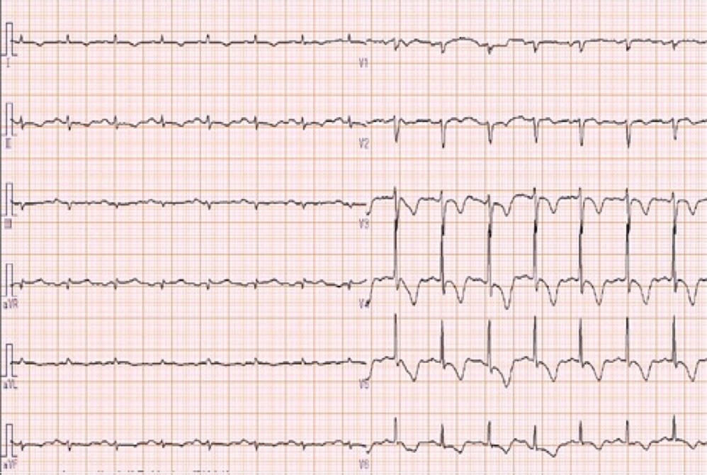 図3　発症翌日のECG