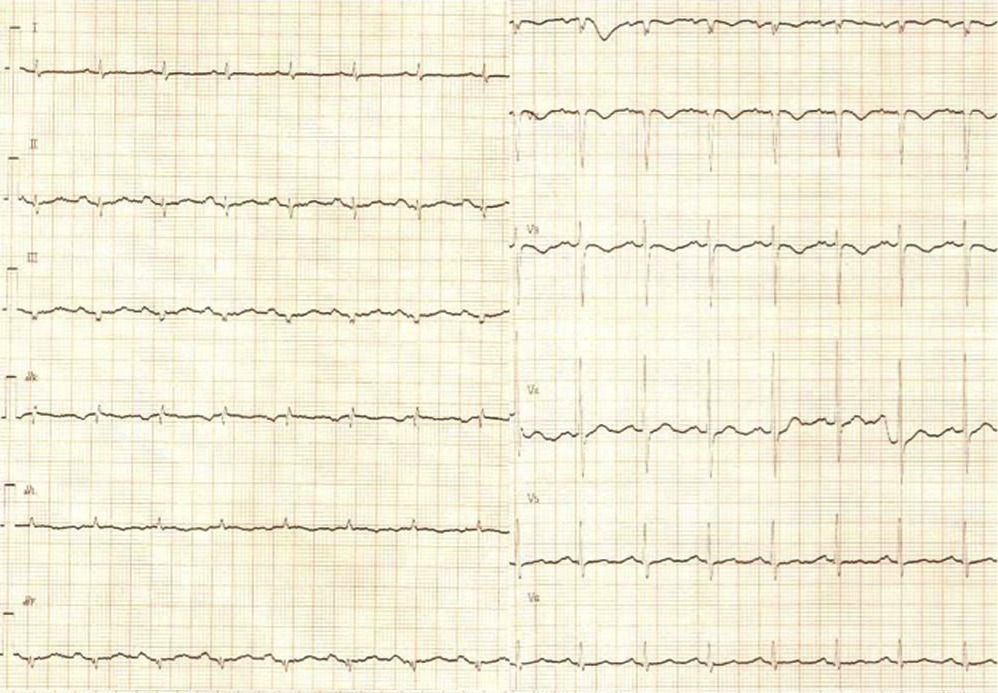 85歳女性の図1入院時ECG