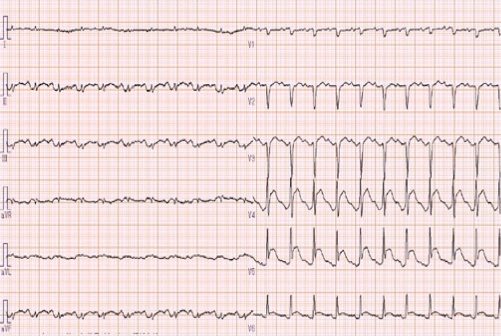 85歳女性の図2入院翌日呼吸困難自覚時ECG