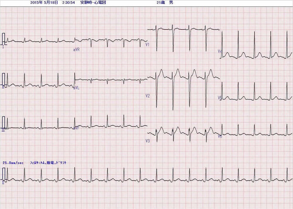 21歳男性の心電図