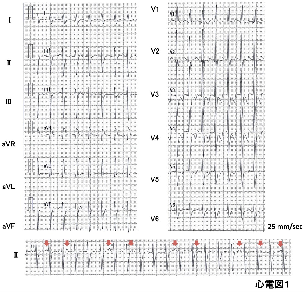 心電図1