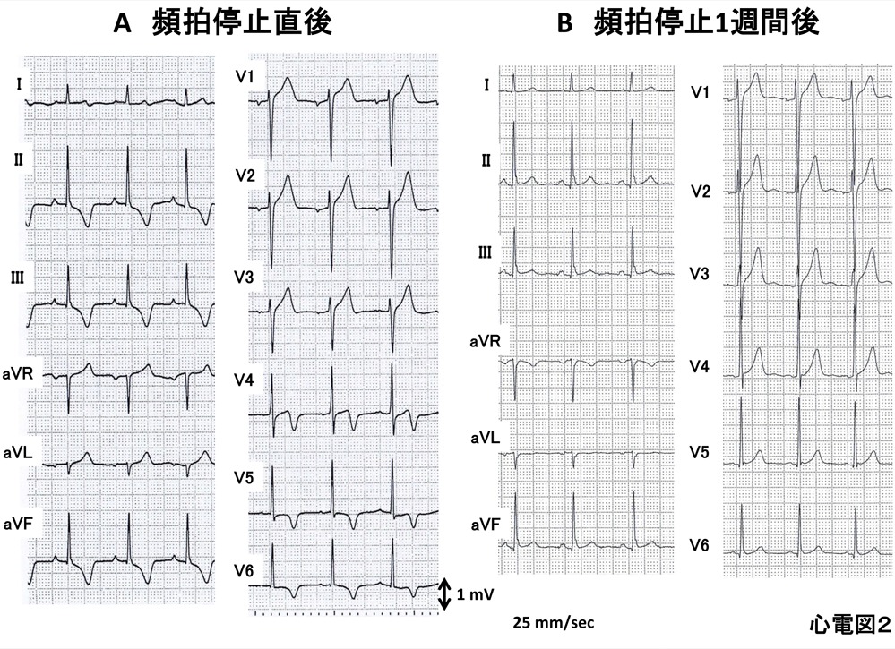 心電図2