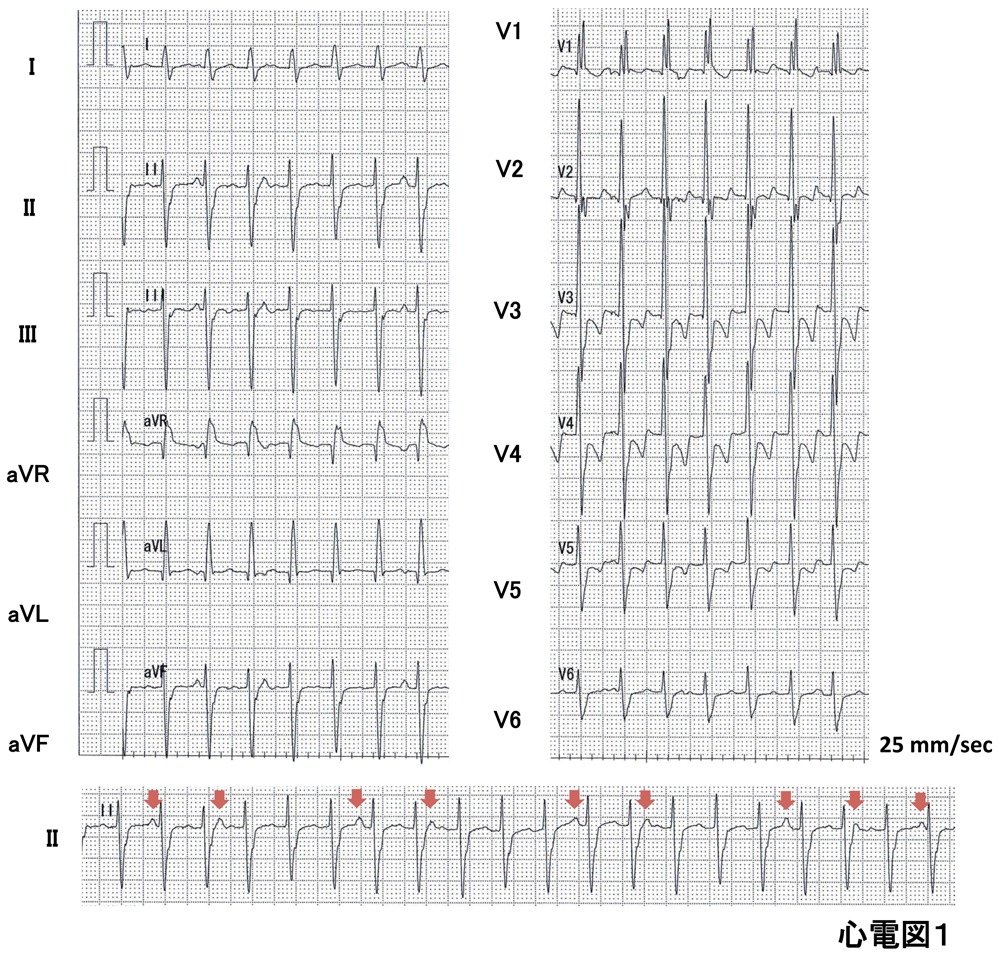 20歳台男性の心電図1