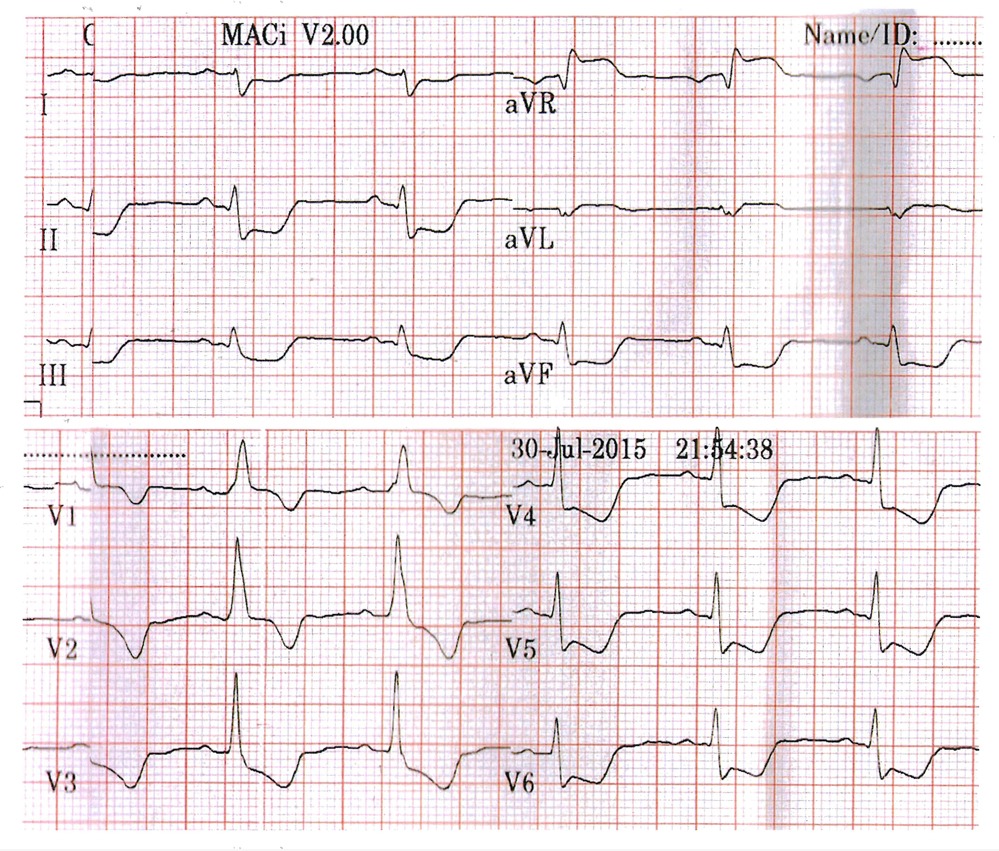 心電図（2015年7月30日、 緊急入院時）