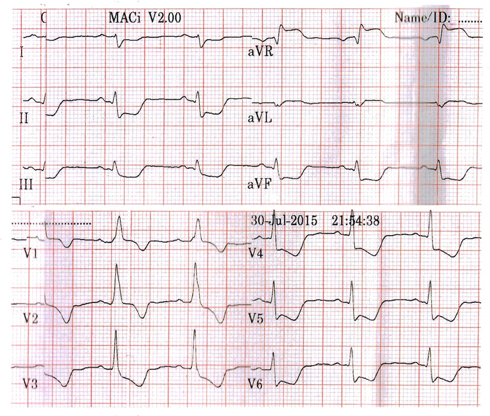 心電図（2015年7月30日、 緊急入院時）