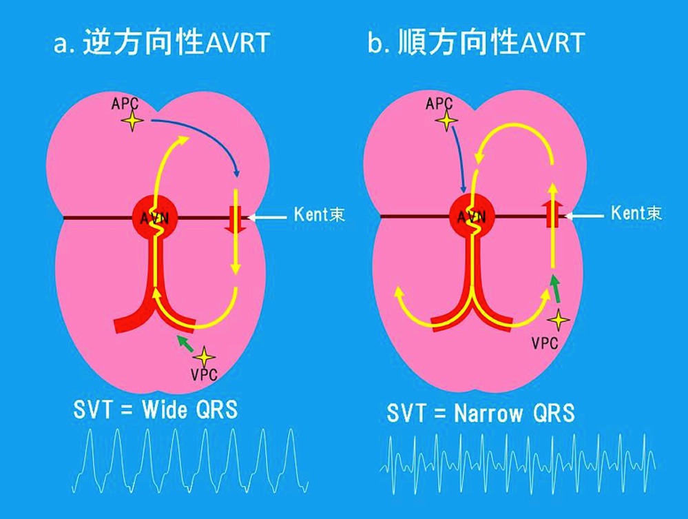 図４　逆方向性AVRT（a）と順方向性AVRT（b）の発症機序APC：上室性期外収縮、VPC：心室性期外収縮、AVN：房室結節