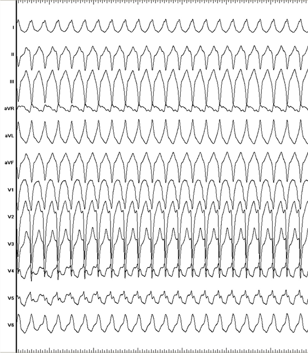  図２　心臓電気生理学的検査で誘発された不整脈の心電図